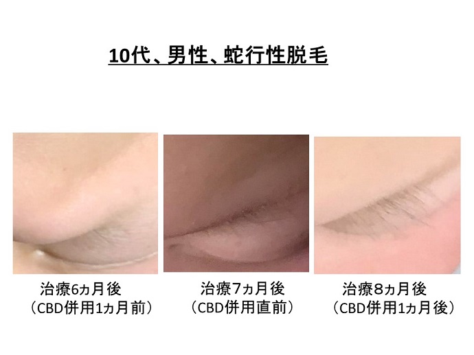 円形脱毛症　病院